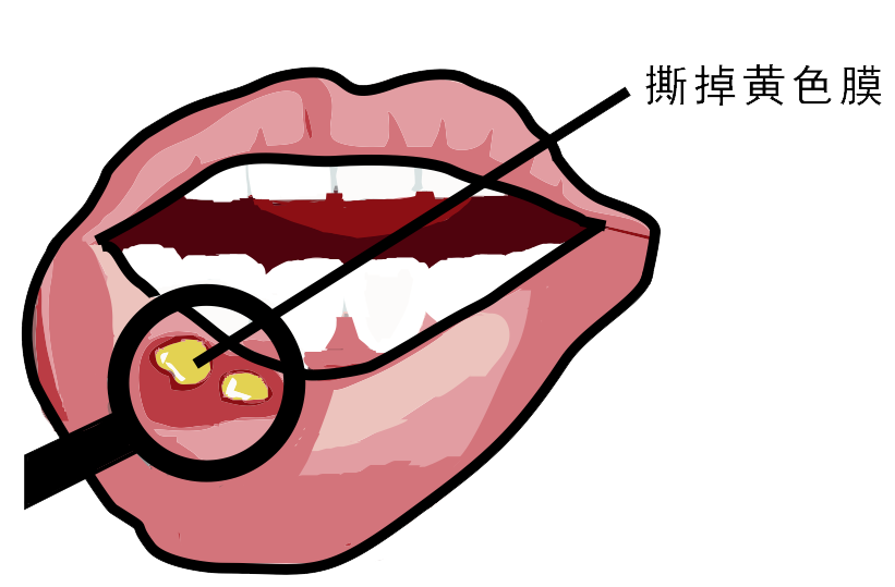 經(jīng)常口腔潰瘍，真的只是缺維生素嗎？