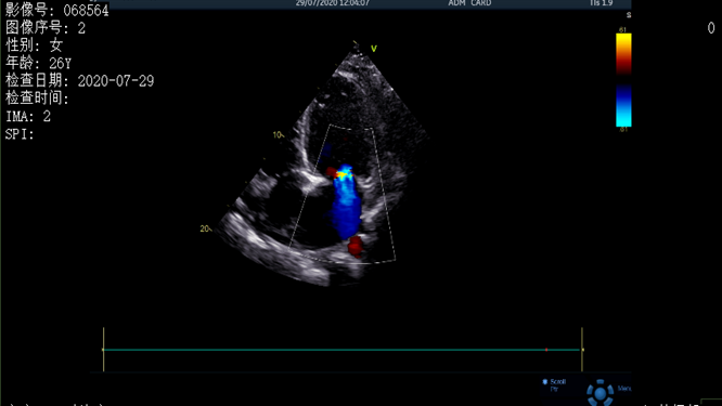 心電圖異常，心臟卻沒事，罪魁禍首是……