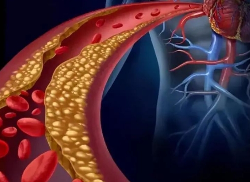 警惕！冠脈支架術(shù)后這些誤區(qū)千萬別踩，趕緊收藏！