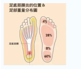 每年新生數(shù)百萬足底筋膜炎患者！國際醫(yī)學(xué)專家提醒：跑步要選擇合適的鞋